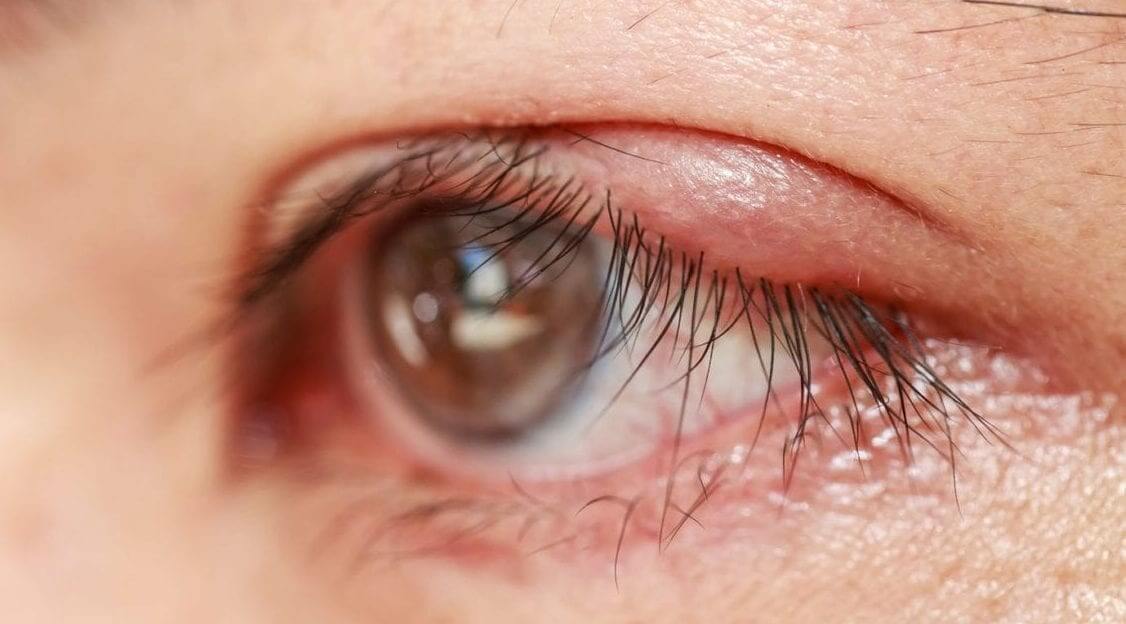 Blepharitis Symptoms Eyelid Treatment Brooks Eye Associates 