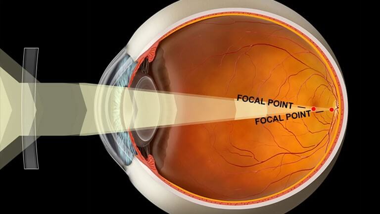 can refractive error cause blindness