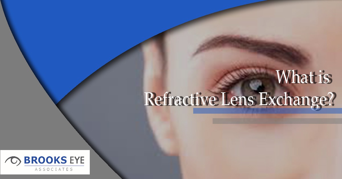 What is Refractive Lens Exchange? | Brooks Eye Associates