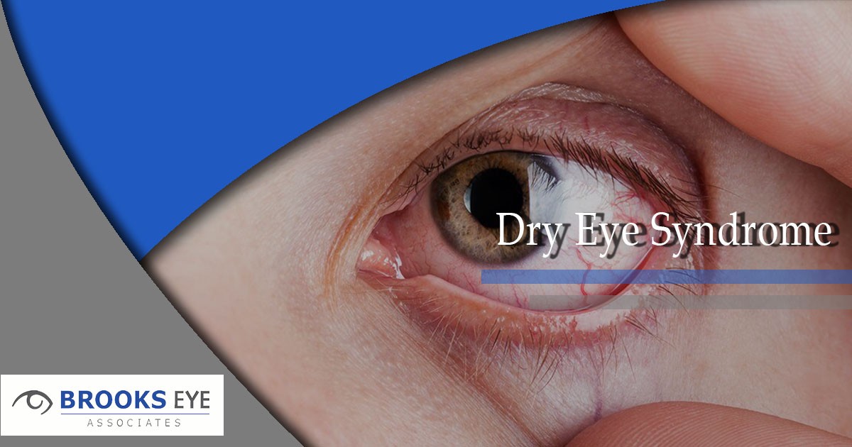 What is Dry Eye Syndrome? | Brooks Eye Associates