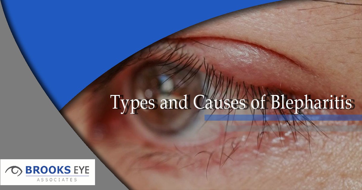 Causes And Treatments For Blepharitis Brooks Eye Associates 